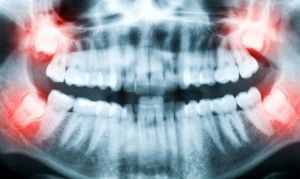 Как снять отек после удаления зуба