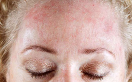 Какие заболевания кожи могут поражать лицо