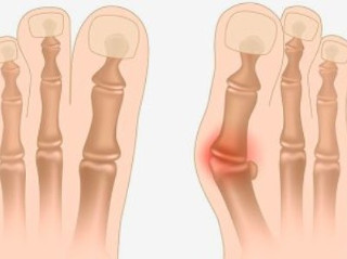 Осложнение вальгуса большого пальца ноги