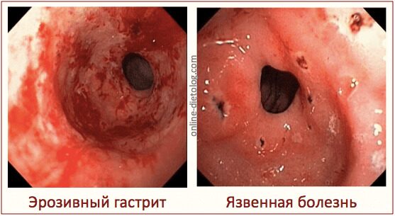 Воспаление слизистой желудка. Фото. Как восстановить слизистую желудка