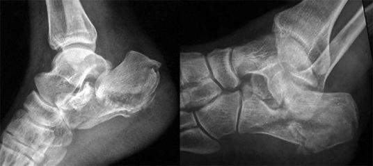  
Внутрисуставной перелом пяточной кости с отрывом бугристости
