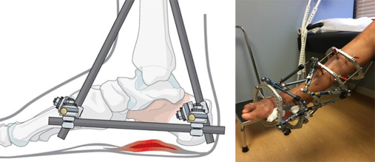  
Варианты использования аппарата внешней фиксации при переломах пяточной кости
