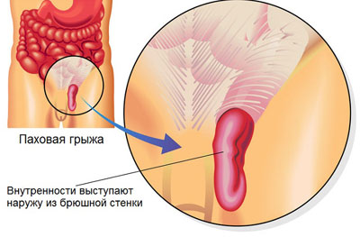 Развитие паховой грыжи