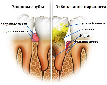 Зубной камень приводит к заболеваниям