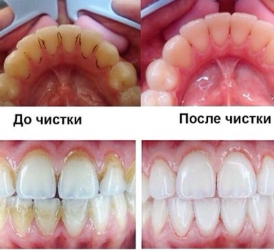Зубы после удаления камня