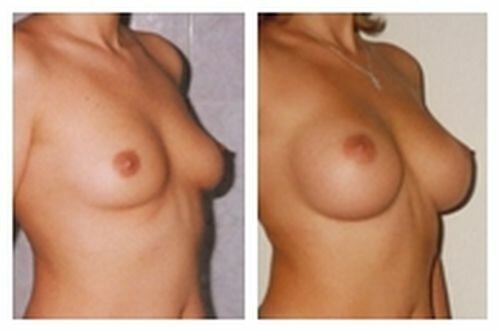 фото до и после установки силиконовой груди
