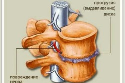 Шейно грудной остеохондроз