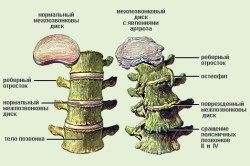 Схема шейного остеохондроза, вызывающего боль в шее