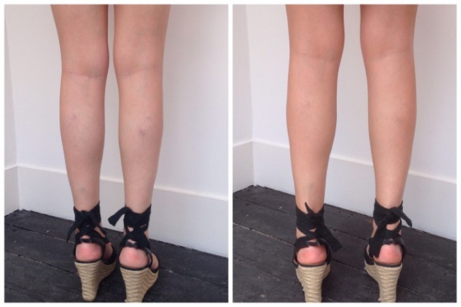 Как исправить кривые ноги в домашних условиях у женщин: как их выпрямить и сделать ровными без операции, ложная и истинная кривизна и комплекс упражнений для корректировки (фото до и после)