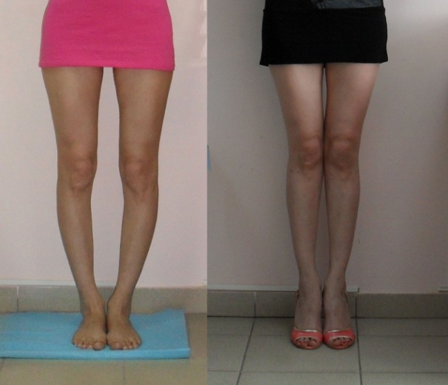 Как исправить кривые ноги в домашних условиях у женщин: как их выпрямить и сделать ровными без операции, ложная и истинная кривизна и комплекс упражнений для корректировки (фото до и после)