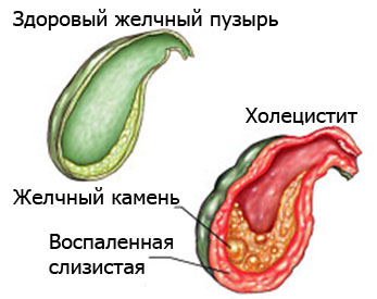 Симптомы холецистита