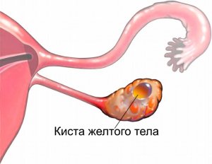 Киста жёлтого тела яичника. Симптомы. Диагностика. Что делать при диагнозе киста жёлтого тела яичника. Консервативное лечение и операции. Платные и бесплатные клиники, в которых лечится киста жёлтого тела яичника.