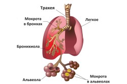 Схема пневмонии
