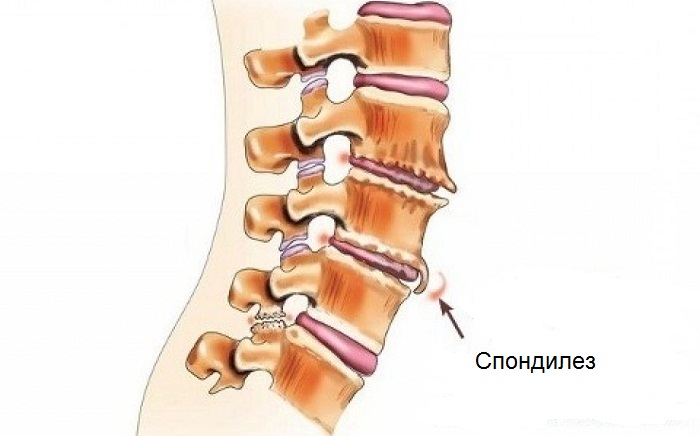 Спондилез