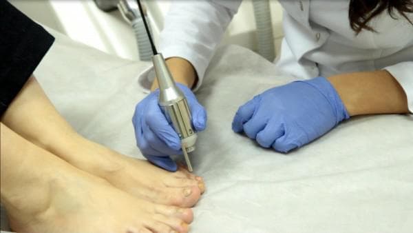 лазерная коррекция ногтей на ногах