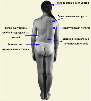 Вторая степень сколиоза у подростков