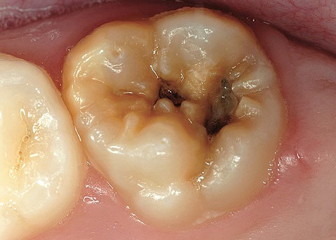 Симптомы кариеса - наличие кариозного пятна или полости