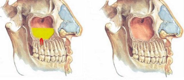 Причины развития одонтогенного синусита