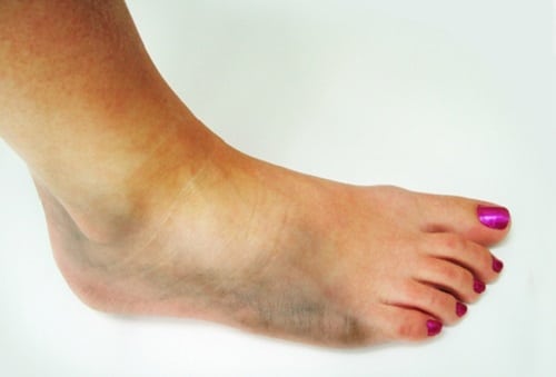 Вывих ноги: лечение, симптомы (фото стопы), признаки