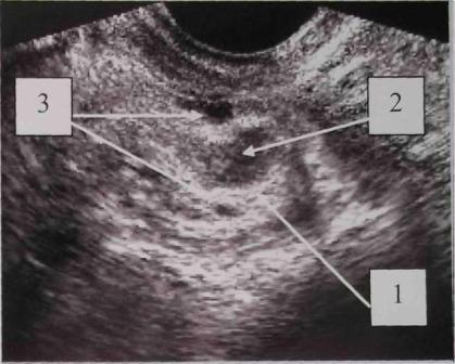 Желтое тело на УЗИ