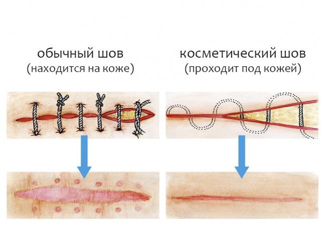 Типы швов