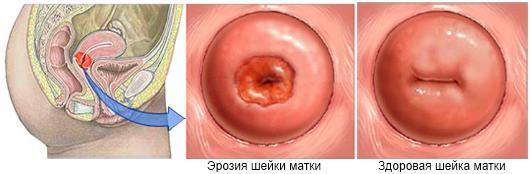 Симптомы эрозии шейки матки