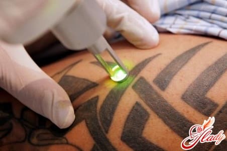 процесс лазерного удаления тату