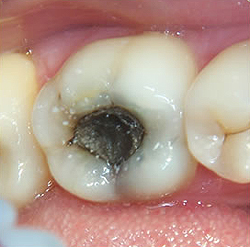 Кариес зуба