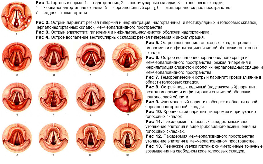 Четыре стадии стеноза гортани