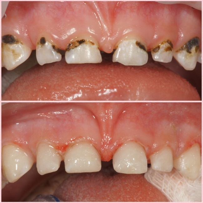 Серебрение молочных зубов: фото во время процедуры и после