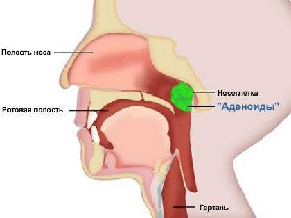 Причины возникновения аденоидов