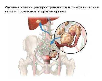 Рак яичников - симптомы, стадии, диагностика