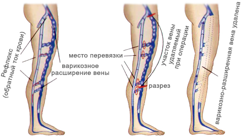 Хирургическое лечение варикоза