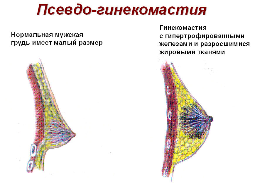 Ложная гинекомастия у мужчин