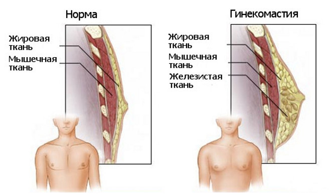 Гинекомастия - причины, симптомы и лечение