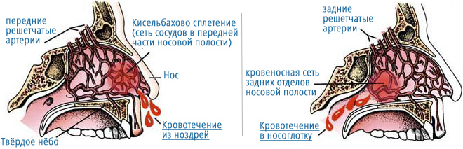 Почему идет из носа кровь?