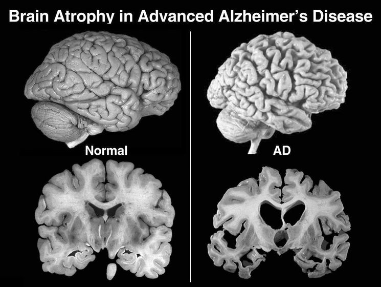 Атрофия мозга при болезни Альцгеймера