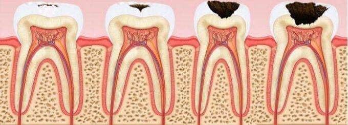 фото со стадиями кариеса зубов
