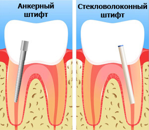 наращивание передних зубов на штифт