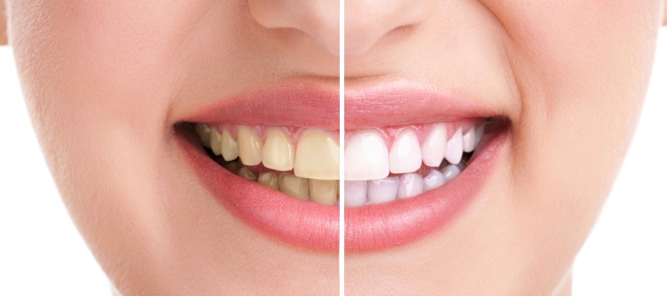 Причины появления желтого налета на зубах