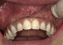 зубы на поднадкостничном имплантате