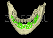 Смоделированный субпериостальный имплантат