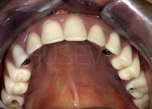 зубы на поднадкостничном имплантате