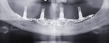 поднадкостничный имплантат рентген