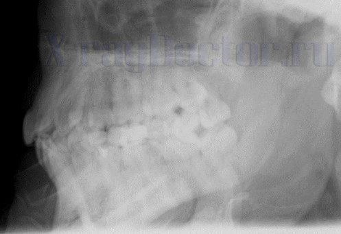 боковой рентгеновский снимок нижней челюсти