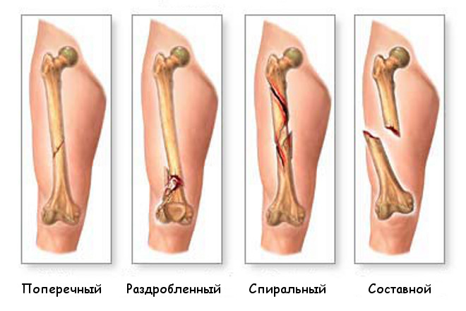 Некоторые варианты перелома кости