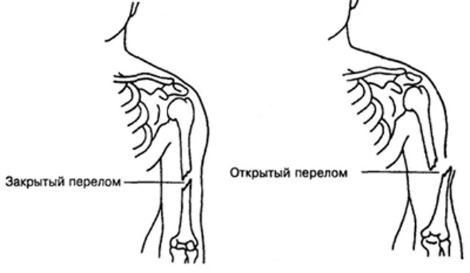 Открытый и закрытый перелом