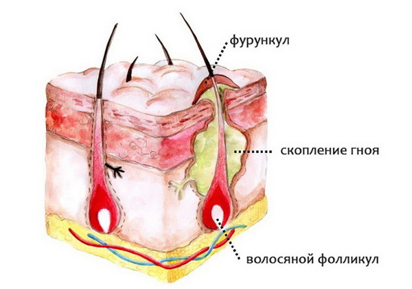 Строение фурункула