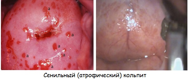 атрофический кольпит