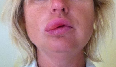 Первым симптомом развития отека Квинке является опухание губ. В этом случае необходимо немедленно вызывать скорую помощь.